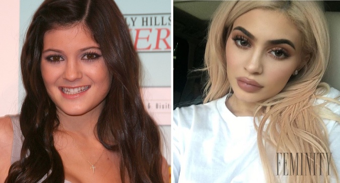 Kylie Jenner roky klamala o zväčšení svojich pier
