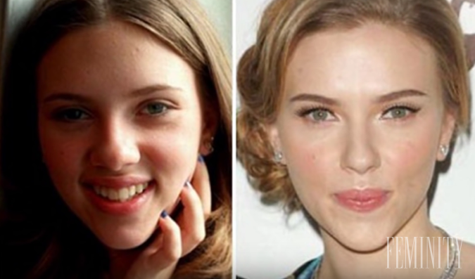 Plastika nosa pomohla k lepšiemu vzhľadu aj Scarlett Johansson