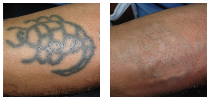 Pred a po absolvovaní zákroku na odstraňovanie tetovania laserom Q-SWITCHED