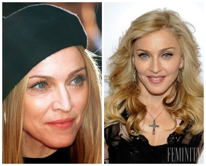 Speváčka Madonna pred, a po drobných úpravách tváre 