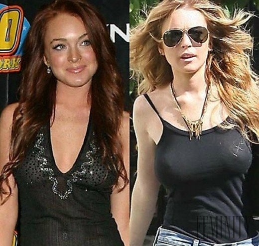 Lindsay Lohan zvolila vzhľadom na svoje telo obrovské implantáty