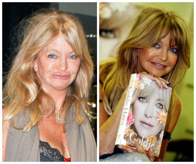 Komička Goldie Hawn tiež popustila uzdu a s plastikami to prehnala